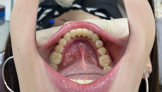  Восстановление эстетики нижнего ряда зубов безметалловыми керамическими коронками из диоксида циркония