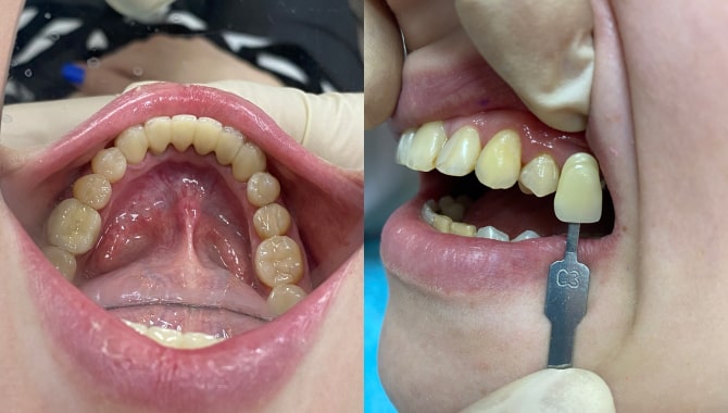  Восстановление эстетики нижнего ряда зубов безметалловыми керамическими коронками из диоксида циркония