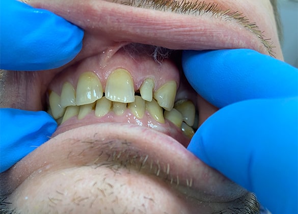 Восстановление зуба циркониевой вкладкой и коронкой E-max
