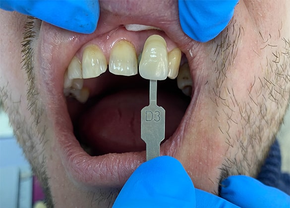 Восстановление зуба циркониевой вкладкой и коронкой E-max